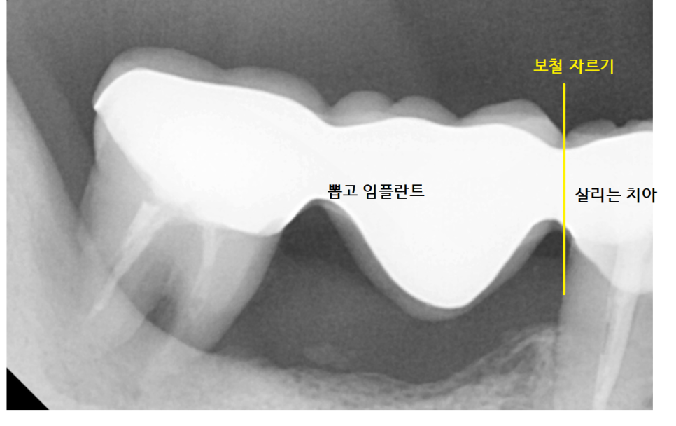 강일역 치과 치아와 임플란트 연결 가능한가요??? 관련 이미지 4