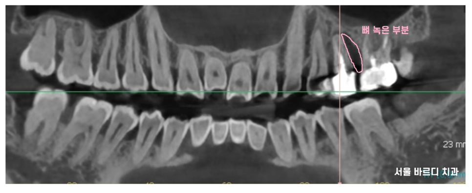 덕풍동 치과 씹을때 통증 임플란트로 극복했습니다. 관련 이미지 4