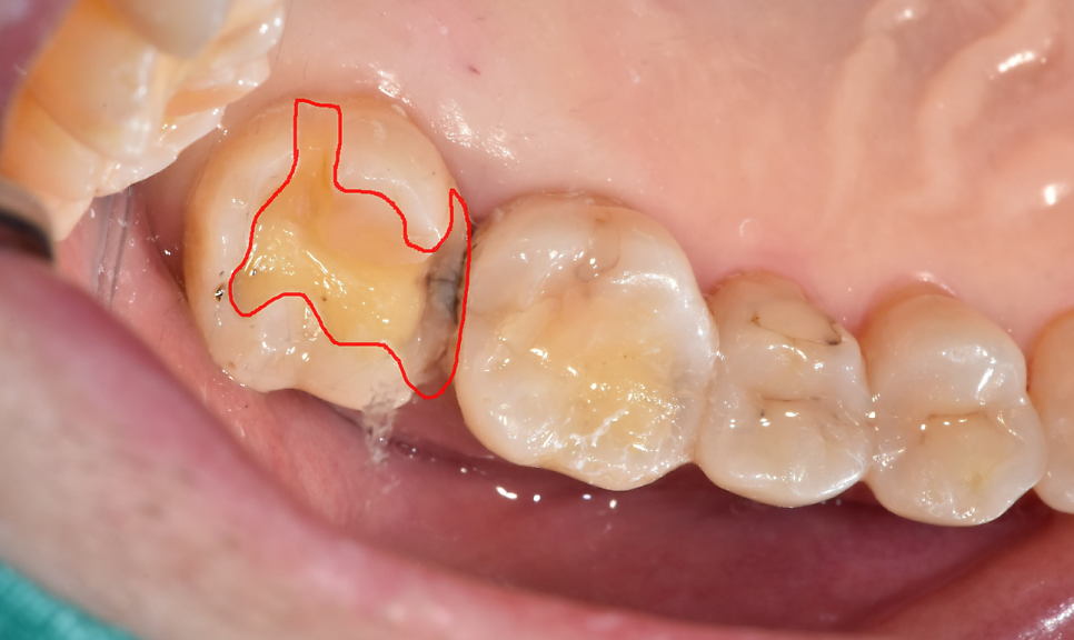 치실 안쓰면 이렇게 됩니다!!  치아 사이 충치 인레이 치료 관련 이미지 8
