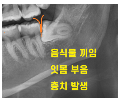 강동구 사랑니 묻혀있는 매복치아 꼼짝마!!! 뽑아줄테니까 관련 이미지 2