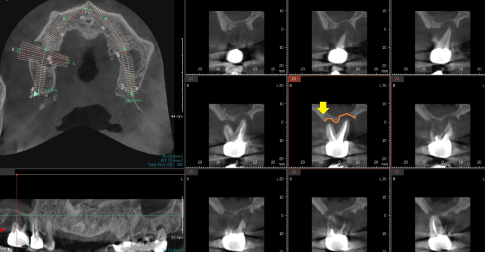 명일역 근처 치과 치아 뿌리 염증이 생겨서 고생하신 사연 관련 이미지 5
