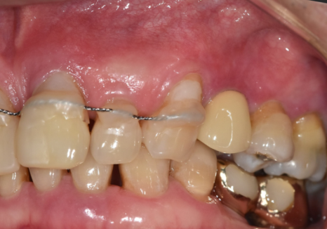 앞니 흔들림, 임플란트 치아보험 감액 기간 넘기려다 더 큰 손해 봅니다. 관련 이미지 4