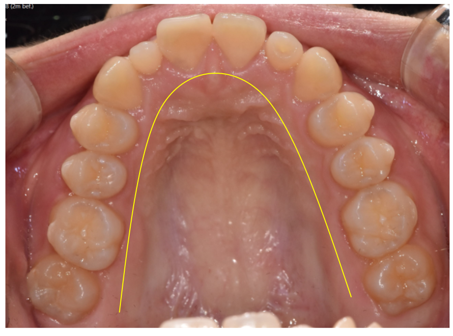 Microdontia Orthodontics Can Restore Balance and Alignment of the Teeth. image 6