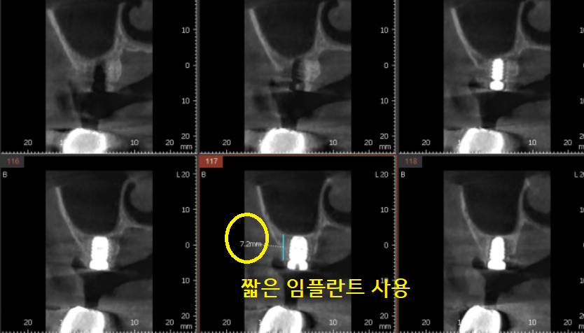 덕풍동 치과 임플란트 불가 판정받으신 환자분 살렸습니다. 관련 이미지 6