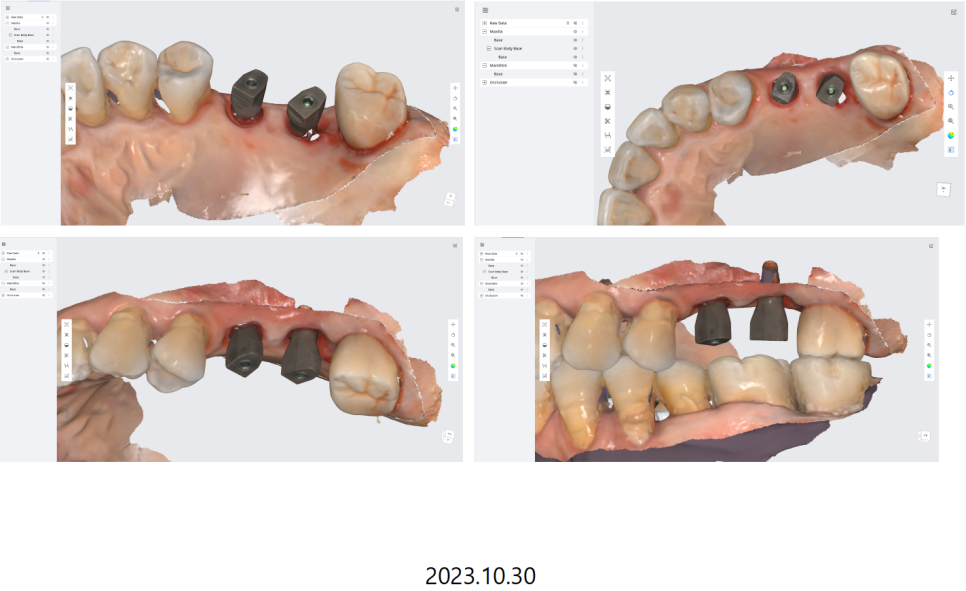 고덕동치과 서울바르디치과 무절개 네비게이션 임플란트 치료증례 #2 관련 이미지 18