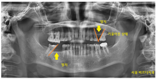 강동구 치과 약먹는게 많은데 임플란트 수술 할 수 있나요?? 관련 이미지 2