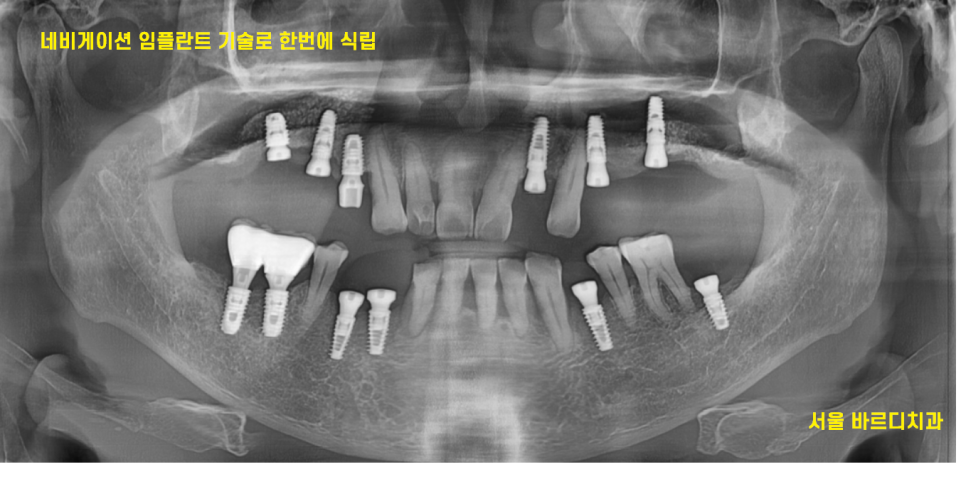 상일동역 근처 치과 타원 임플란트 제거 후 재식립 케이스 관련 이미지 7