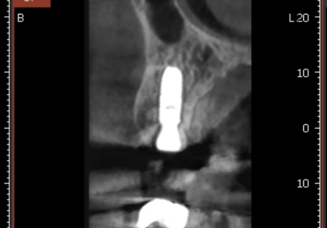 아스피린 복용 중인데 임플란트 수술, 가능할까요? 아스피린 얼마나 끊어야 하나요? 관련 이미지 9