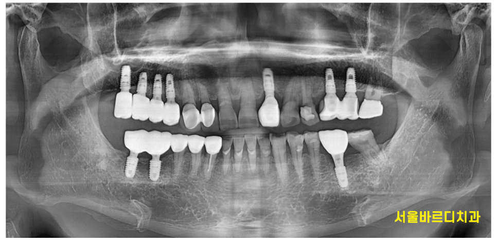 고덕역 교정치과 40대인데 치아 교정 가능한가요? 관련 이미지 4