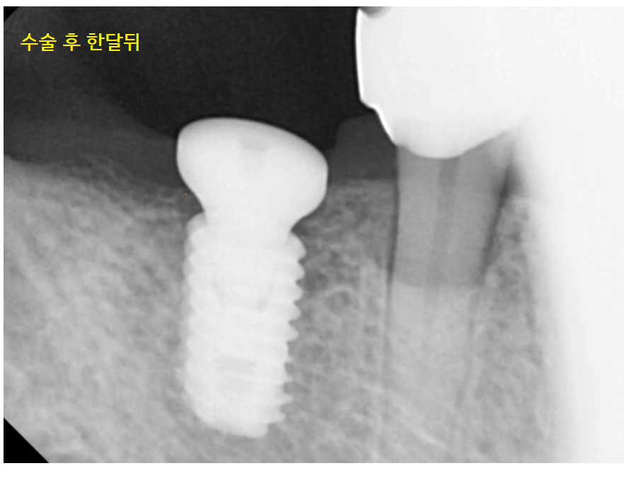 오래된 브릿지 보철 제거 후 고덕역 임플란트 교체 케이스 관련 이미지 7