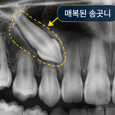 아이 덧니, 지금 교정해야 하나요? 아니면 더 기다릴까요? 교정 시점 관련 이미지 2
