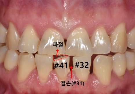 Spaces Between Front Teeth Due to Congenital Missing Teeth: Is Orthodontic Treatment the Only Answer? image 3