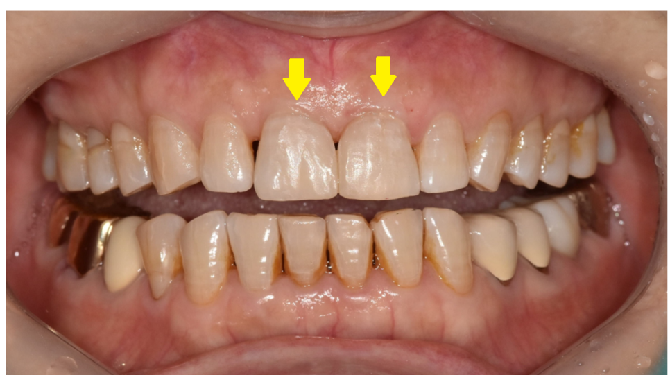 깨지고 벌어진 앞니 사이 레진으로 공간 재분배하였습니다. 관련 이미지 5