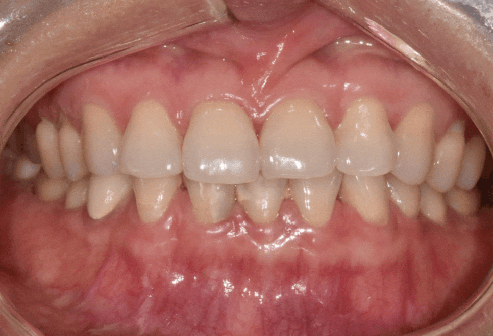 앞니 레진 떨어짐, 자꾸 반복된다면 관련 이미지 7