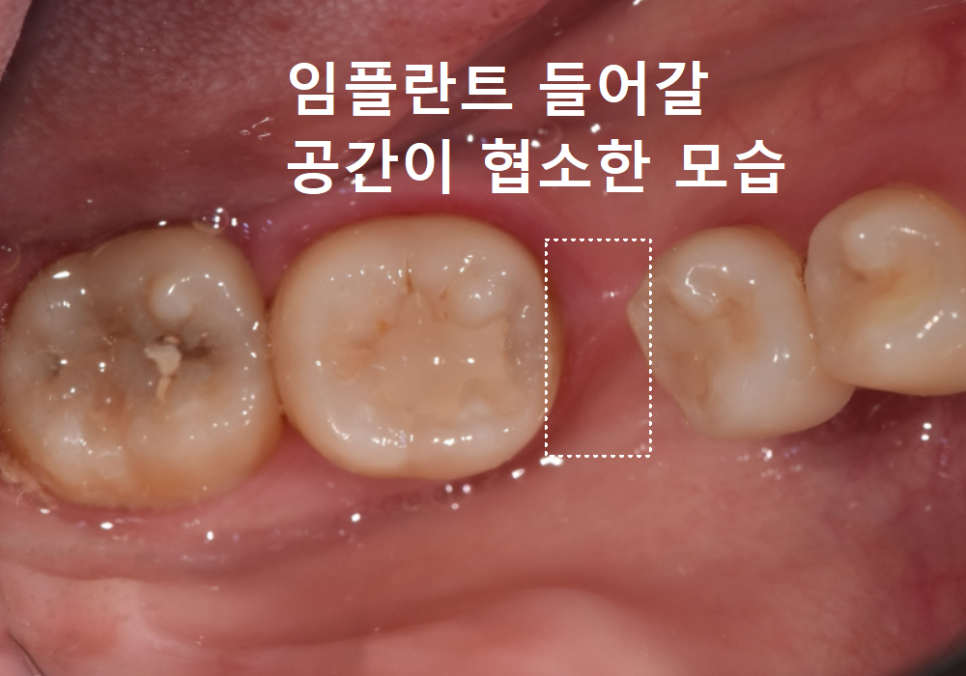 No space for an implant because a tooth has fallen over or a molar has tilted? Read this first. image 7