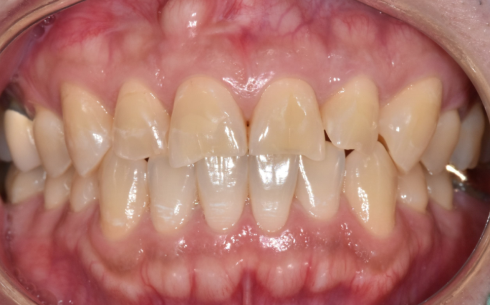 앞니 깨졌을 때, 치아 파절 실비 가능한가요? 관련 이미지 4