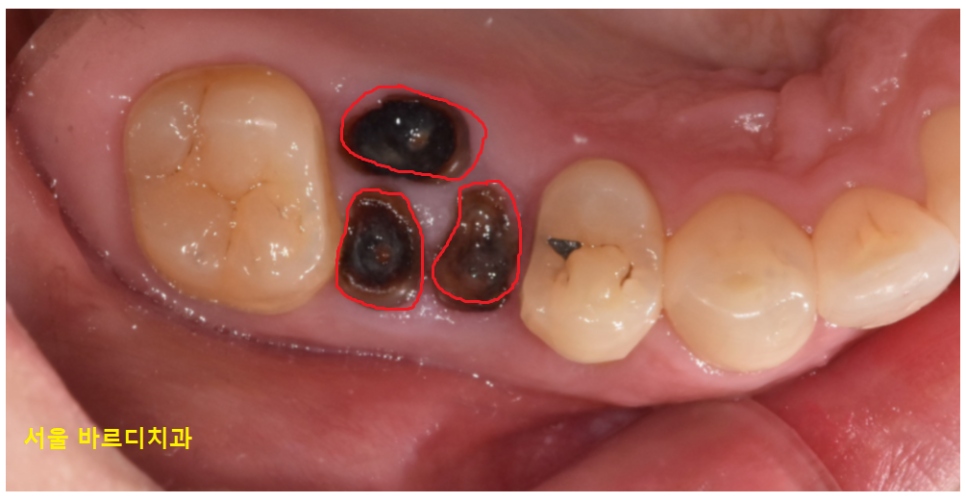 풍산동 치과 임플란트 양쪽 치료 가능한가요? 관련 이미지 7