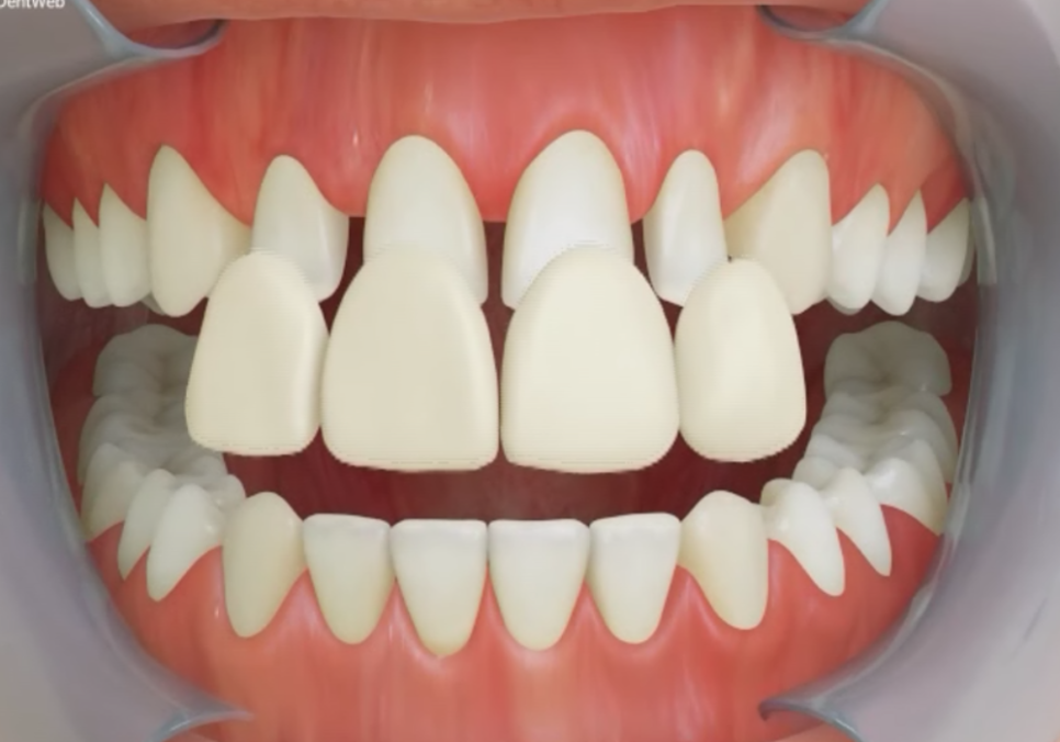 앞니 끝부분 깨짐, 다듬기, 레진, 라미네이트? 어떤 치료가 나에게 적합할까? 관련 이미지 3