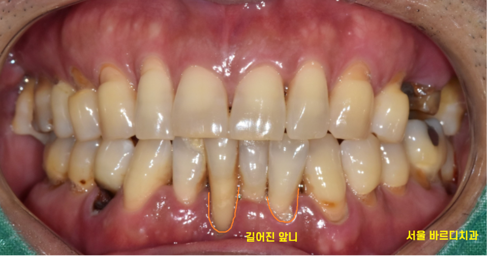 둔촌동 치과 아래 앞니 임플란트 뼈가 없을 때 일체형으로! 관련 이미지 4