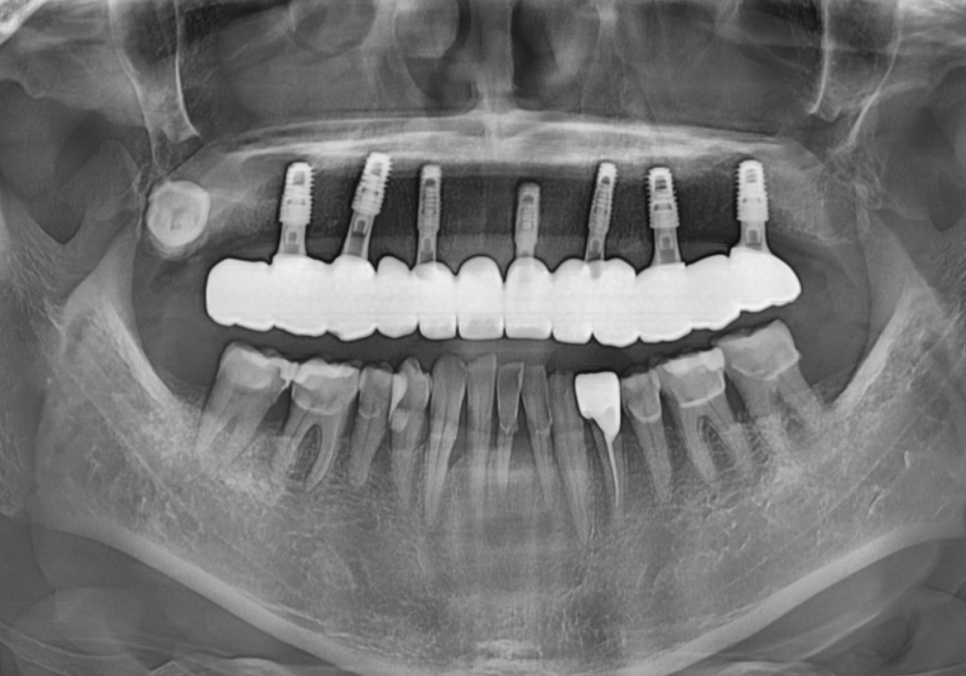 위 턱 전체 임플란트 vs 부분 틀니, 나에게 꼭 필요한 치료법 찾기 관련 이미지 15