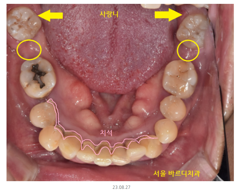 길동 치과 임플란트 뼈이식 흡연 관련 있을까? 관련 이미지 4