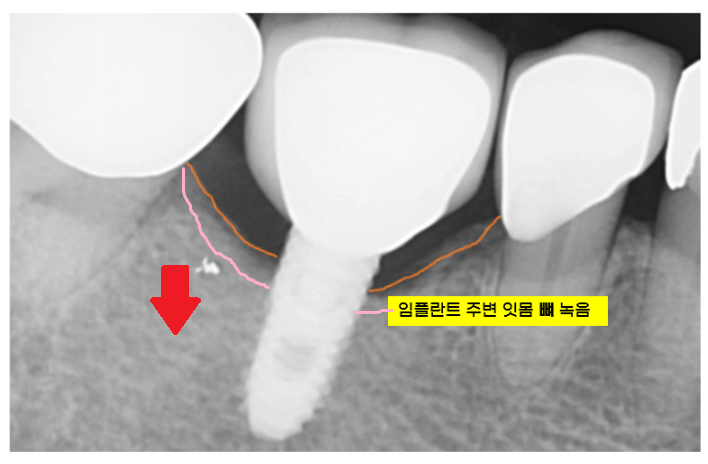 상일동 치과 임플란트 심 박는 것이 무엇인가요? 관련 이미지 4