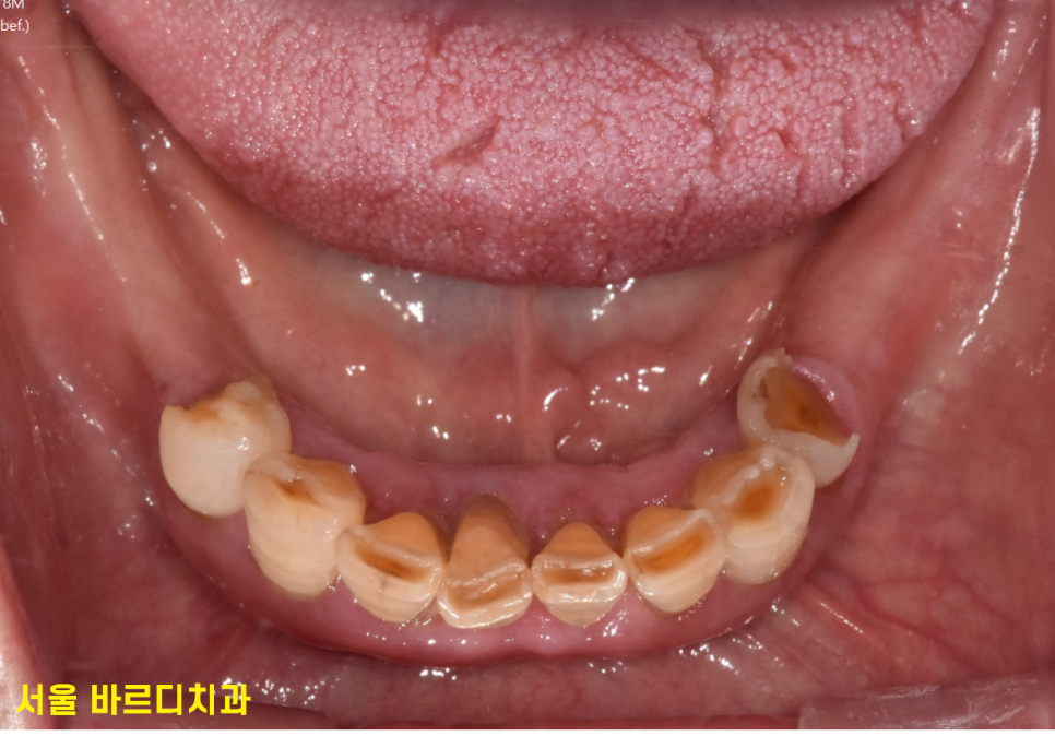 전체적인 치아 치료 13개의 임플란트를 식립한 환자분 관련 이미지 4