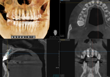 잇몸 까매짐 원인,증상,치료 방법 오래전에 앞니 씌운 곳 잇몸이 까매졌어요. 관련 이미지 8