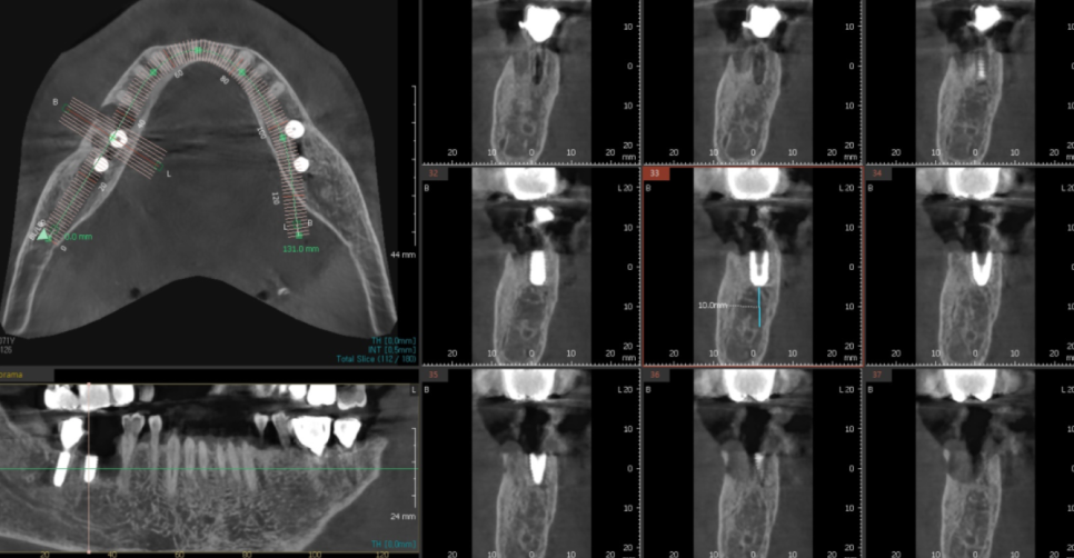 암사동 치과 치아 뿌리 균열 금 갔을 때 임플란트 치료로 행복해지세요. 관련 이미지 4