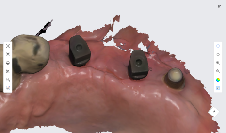 네비게이션 임플란트가 왜 좋다고 그러는거죠? (feat.13가지 장점) 관련 이미지 15