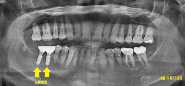 길동 치과 임플란트 2차 수술이요? 예전에 했잖아요 관련 이미지 9