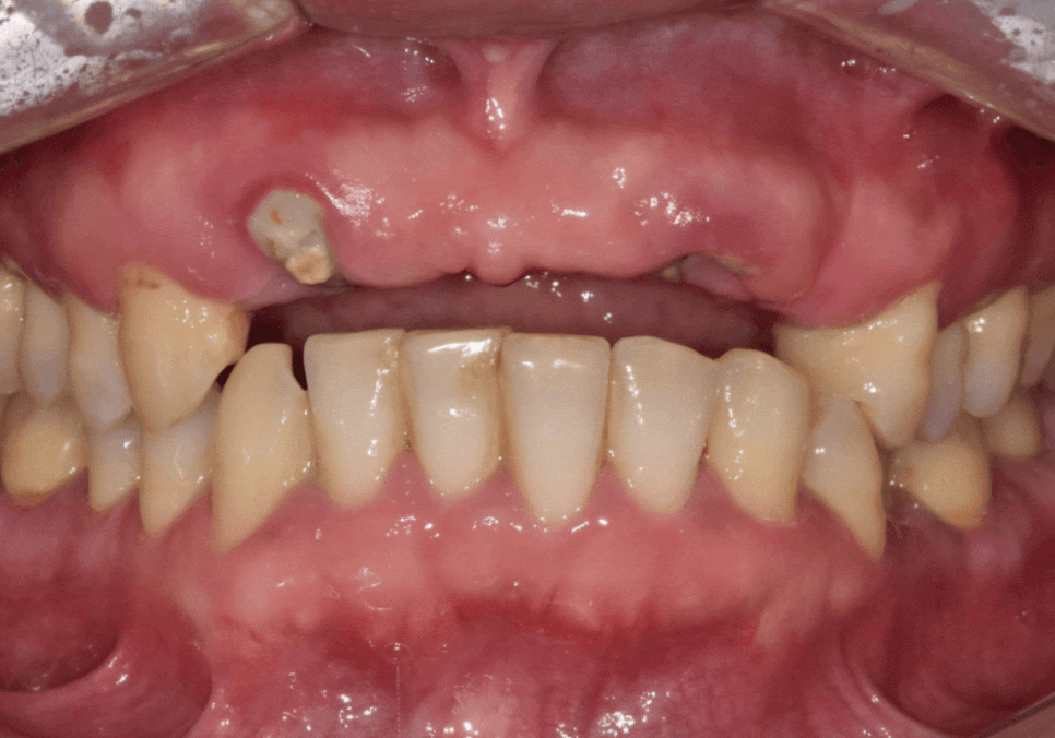 앞니 브릿지 부러짐, 이런 상태라면 절대 브릿지 다시 하지 마세요. 관련 이미지 17