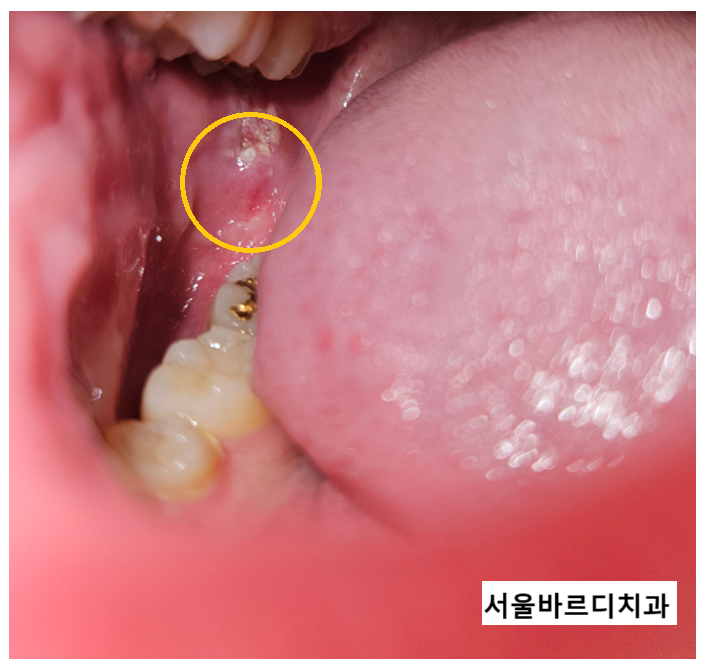 교정기 철사 찔림 원인과 대처법은? 관련 이미지 2