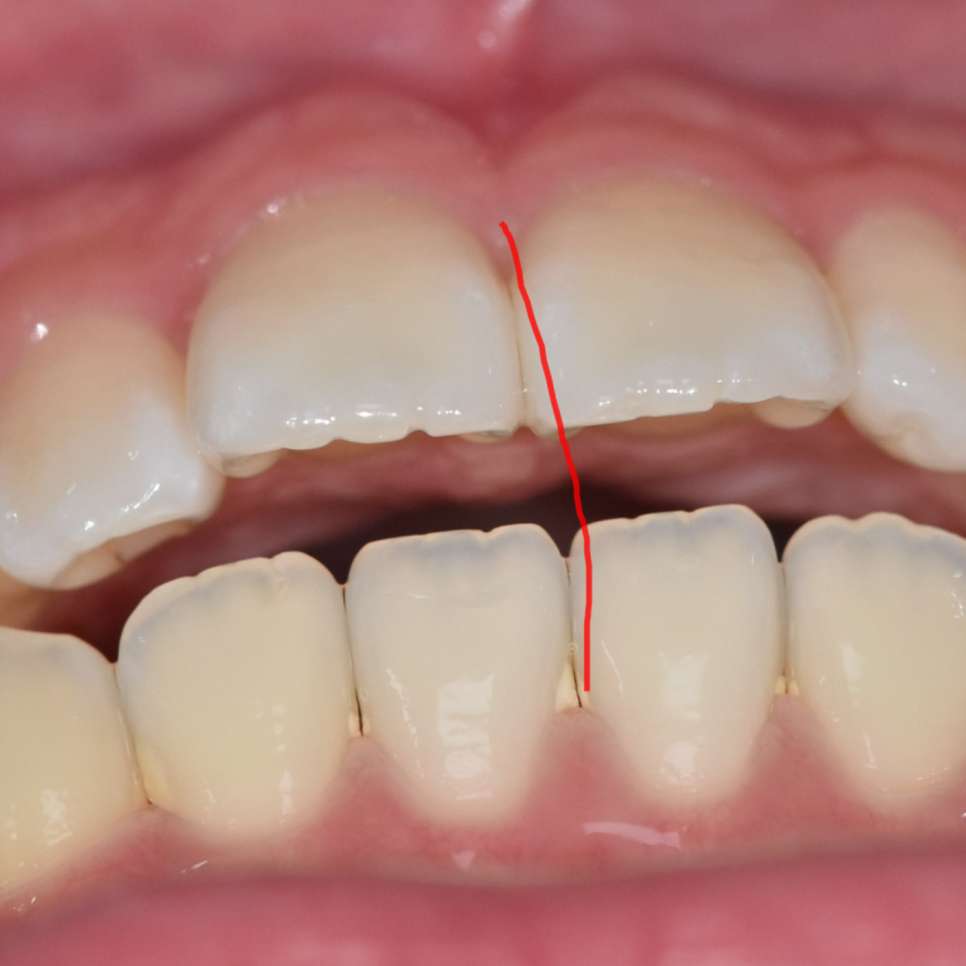 Can Protruding Mouth Be Corrected with Orthodontics Alone, Without Surgery? Sangil-dong Orthodontic Clinic image 9