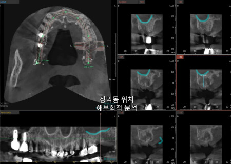 서울바르디치과 뿌리 끝 염증 심한 치아를 네비게이션 임플란트 #6 관련 이미지 8