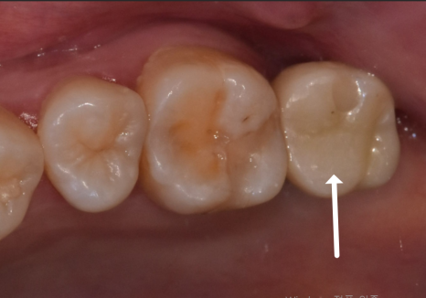 If you lightly brush your backmost molar because the toothbrush can’t reach it, this is what happens. image 17