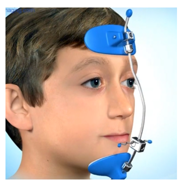 어린이 치아교정 시기 언제가 적기일까?? 관련 이미지 2