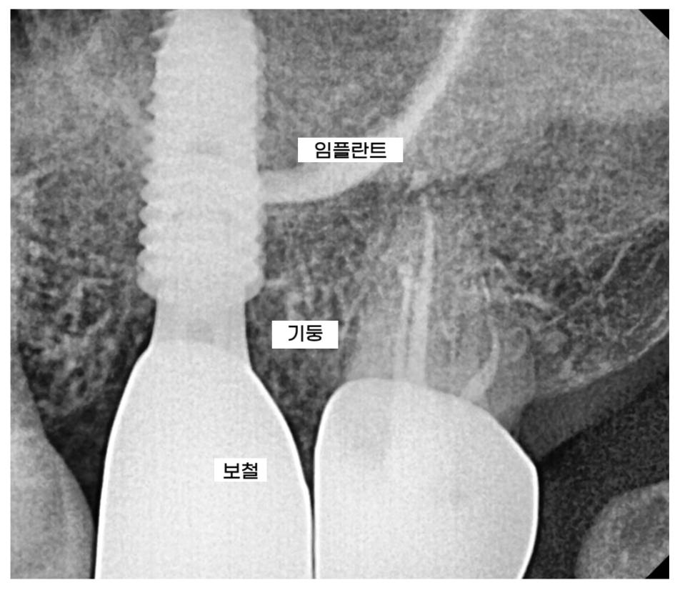 임플란트 나사 조임 통증 언제까지? 대처법까지 공개! 관련 이미지 5