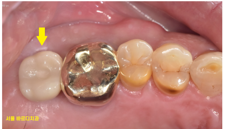 강동구 임플란트 뿌리 염증 심해질경우 대처 방법 관련 이미지 8