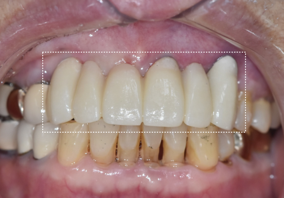앞니 고름, 잇몸약을 먹어도 왜 염증이 가라앉지 않을까요? 관련 이미지 15