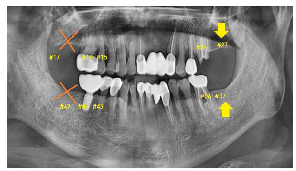 암사동 치과 임플란트 꼭 안 해도 되는 경우 궁금증 해결해 드려요 관련 이미지 10