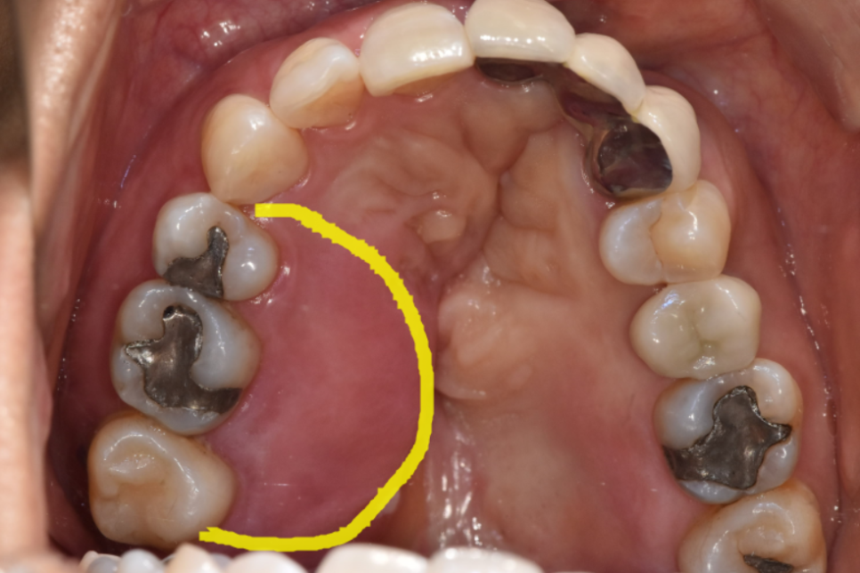치아 뿌리 염증 빼야 된다는 치아, 이렇게 살렸습니다. 치료 방법 관련 이미지 4