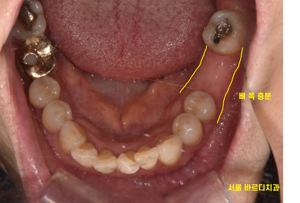 풍산동 치과 아래 어금니 임플란트 뼈 이식 없이 해결했습니다. 관련 이미지 3