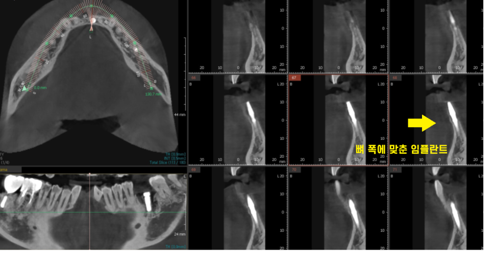 둔촌동 치과 아래 앞니 임플란트 뼈가 없을 때 일체형으로! 관련 이미지 6