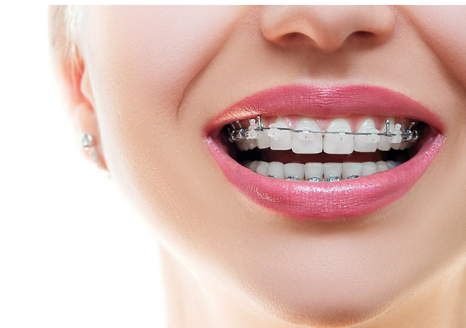 상일동 치아 교정 고려해봐야할 2가지 요소 관련 이미지 2