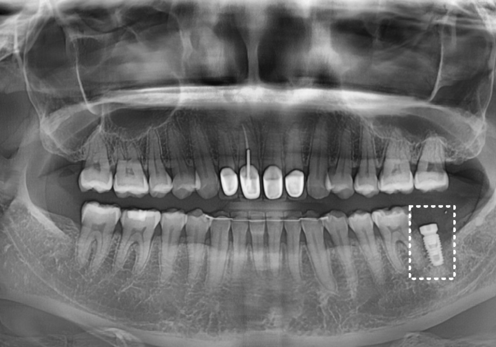 강동구 치아 뿌리 염증, 신경치료 한 치아인데도 아플 수 있나요? 관련 이미지 11