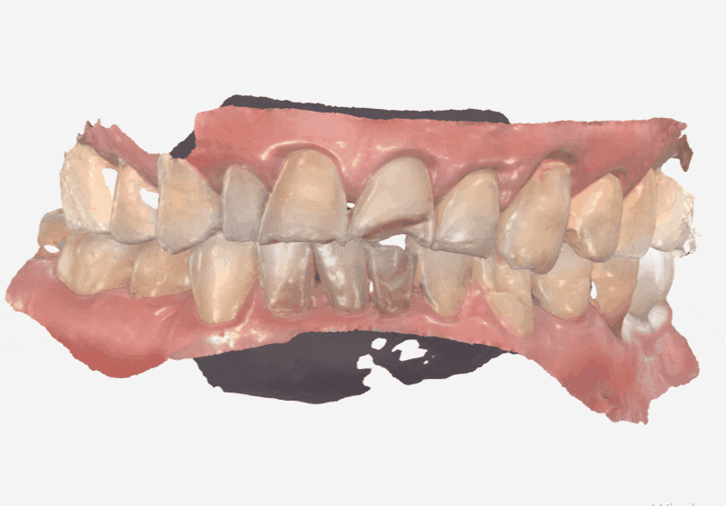 Gangdong-gu Dental Impressions: Are You Still Biting Down for 5 Minutes? We’ll Make It Comfortable with an Intraoral Scanner! image 3