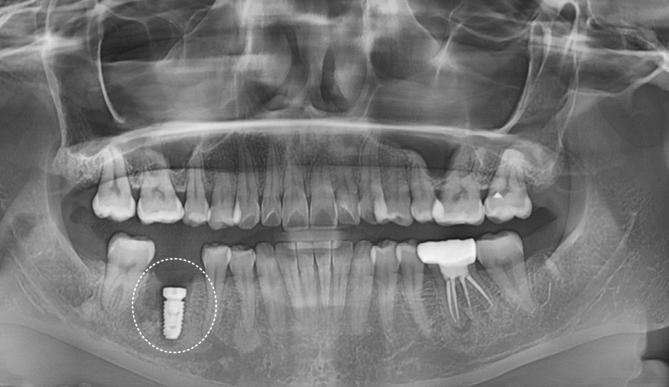 고덕동 20대 임플란트, 시기 놓치면 비용 2배 이상 듭니다. 관련 이미지 8