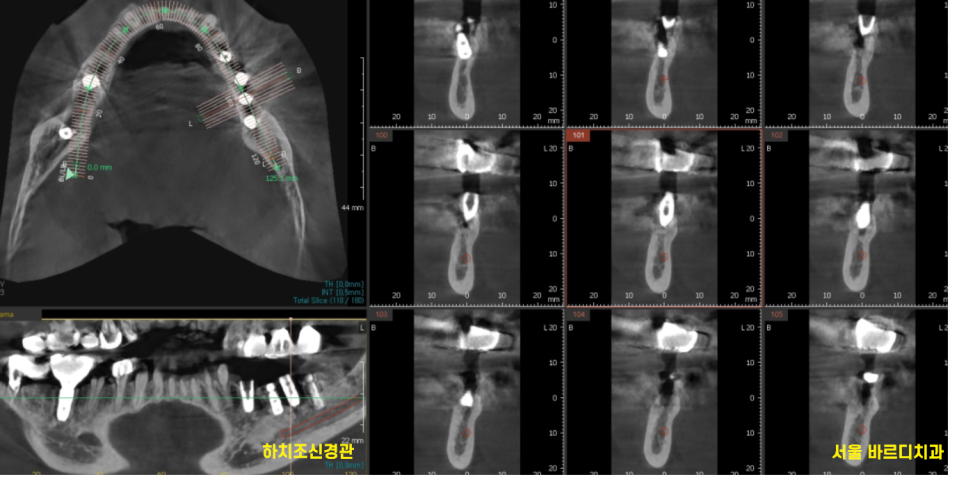 고덕동치과 이가 다 부서졌을 때 임플란트 치료했습니다. 관련 이미지 8