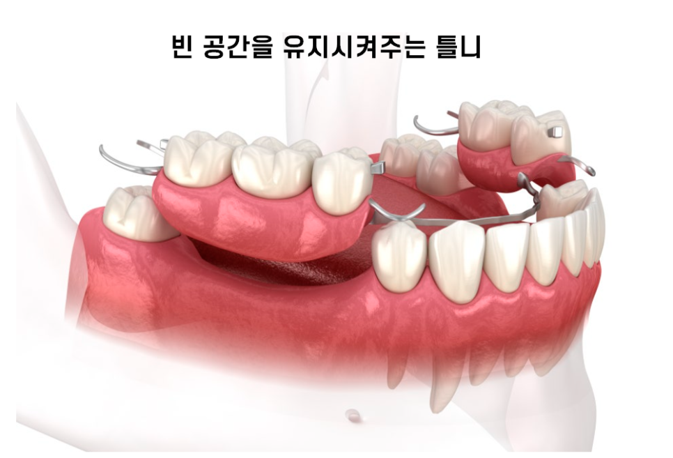 풍산동 임플란트 이 뽑고 임시틀니는 꼭 해야하나요? 플리퍼란? 관련 이미지 2
